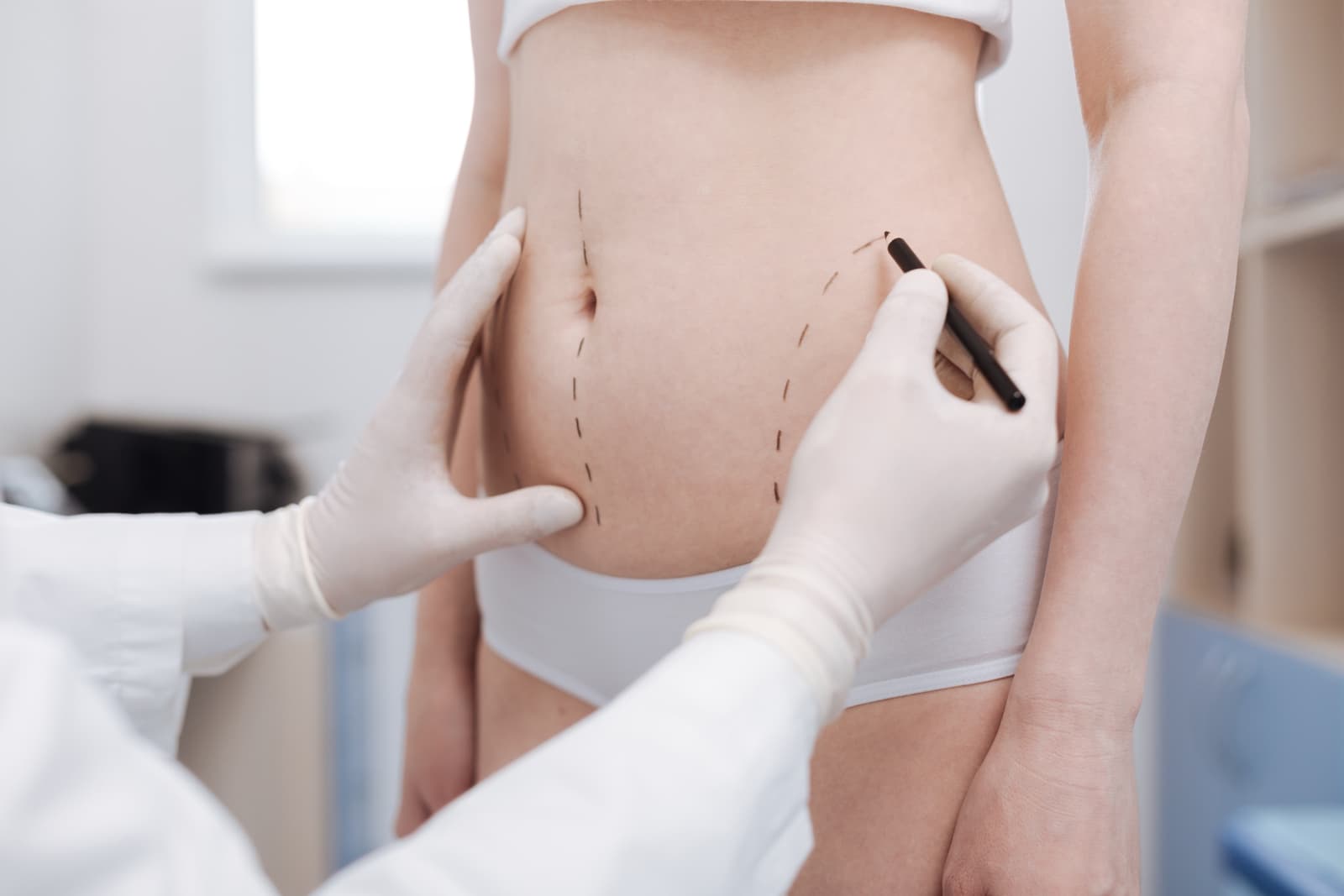 A gloved hand draws dashed incision lines on a woman's abdomen before surgery.