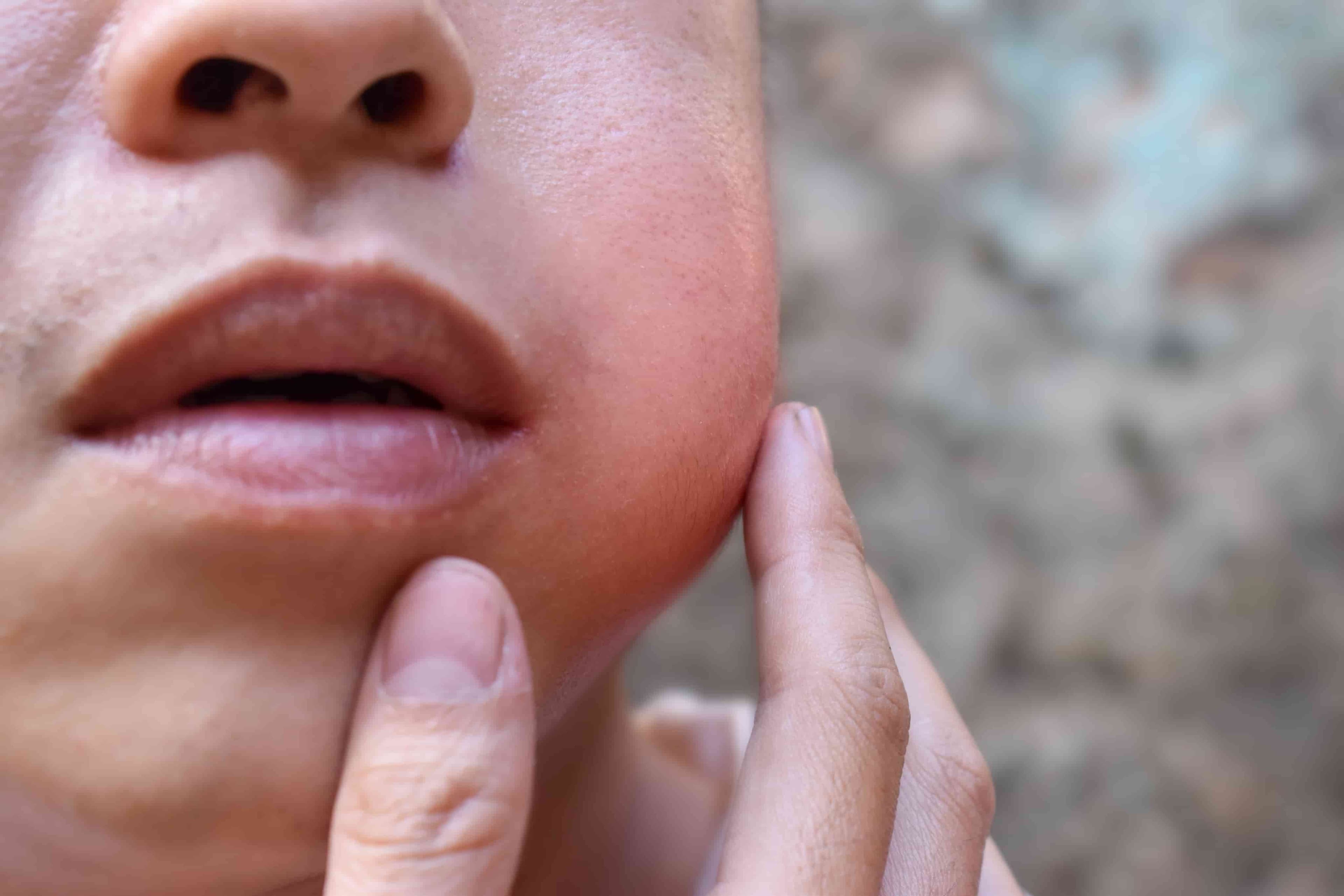 A closeup of a person's cheek with swelling and redness.