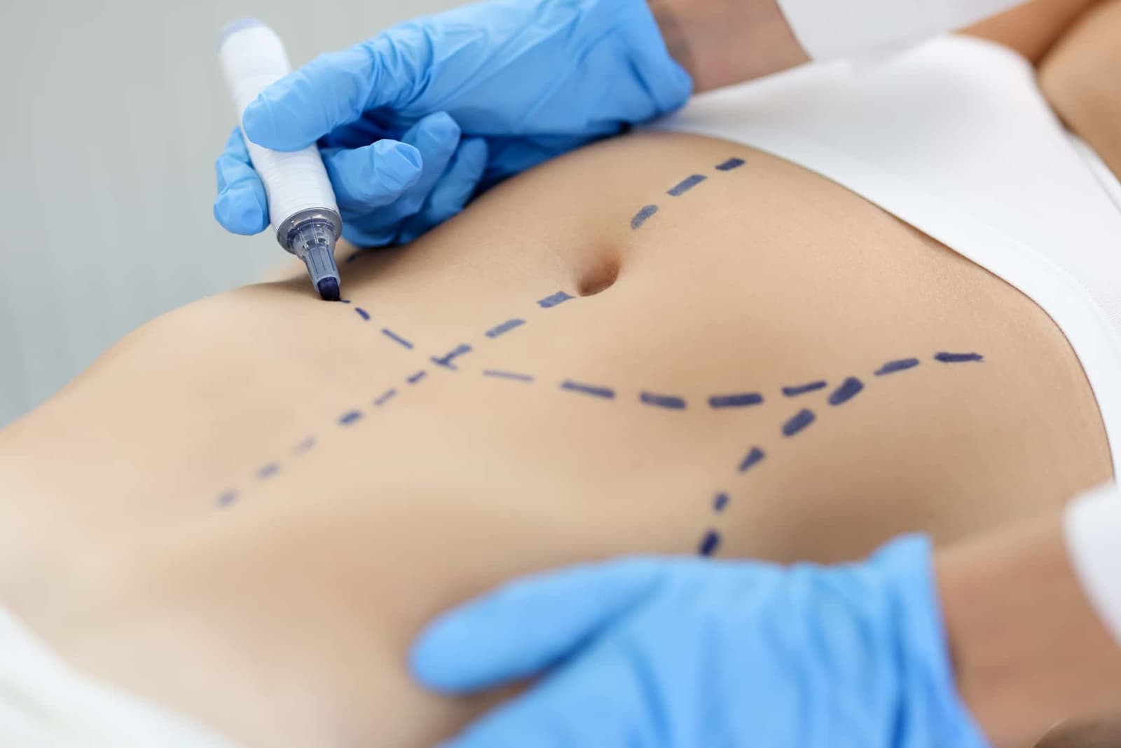 A surgeon is marking a patient's abdomen before a tummy tuck surgery.