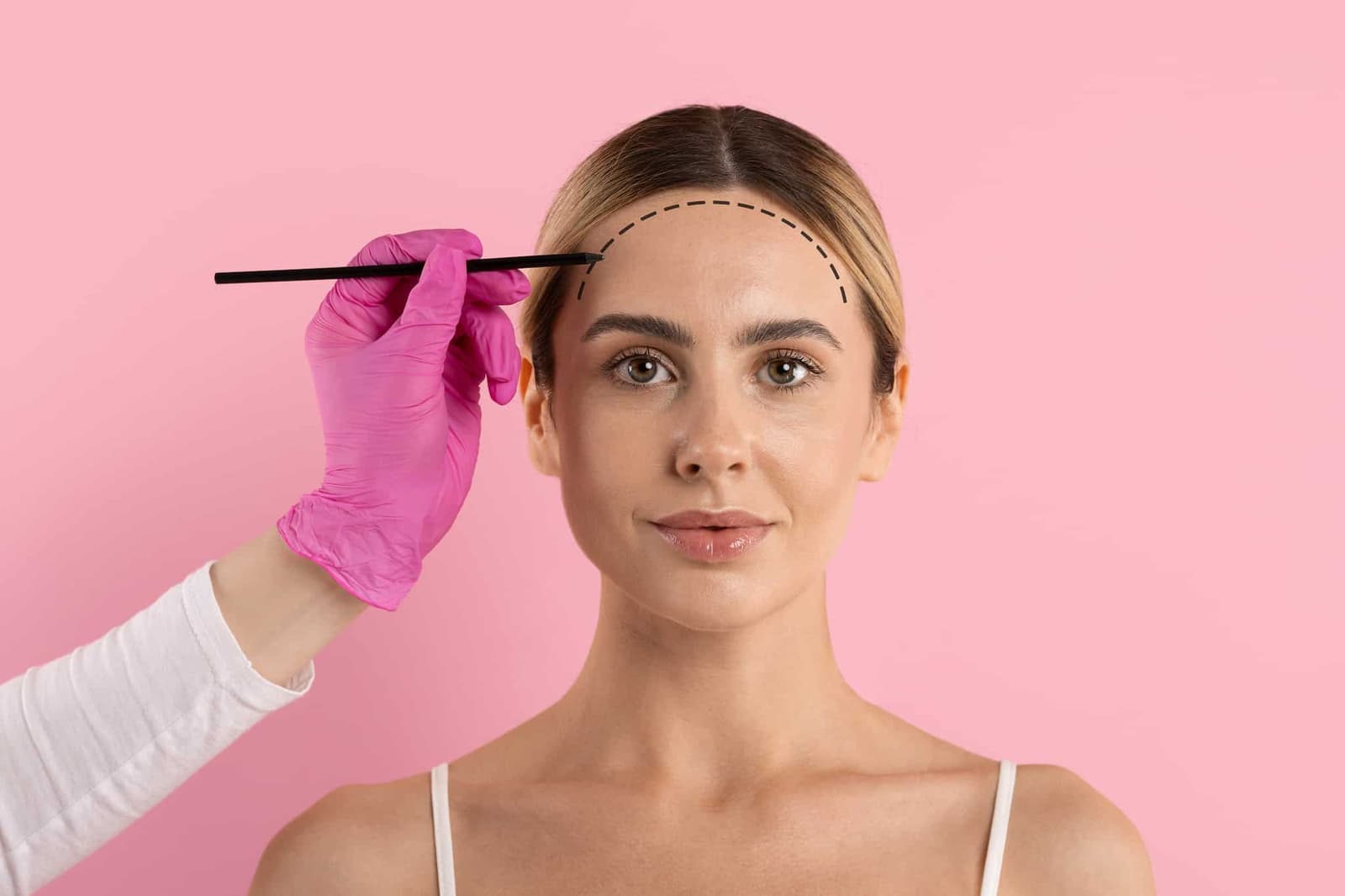 A gloved hand draws a dashed incision line along a woman's hairline before a procedure.